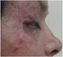The same eye after treatment of the burn scar