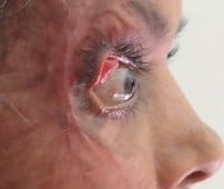 Burn scar pulling the lower eyelid down, before treatment