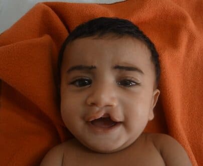 Cleft lip before