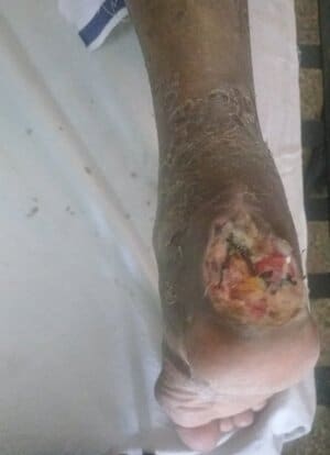 Infected diabetic ulcer