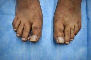 Ingrowing toenail on the big toe