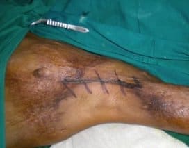 Burn scar on the leg, during surgery