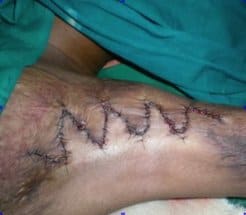 The same scar after surgery, closed with zig-zag stitches