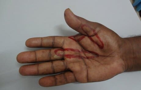 Hand with Dupuytren's disease, with the cords marked on the palm