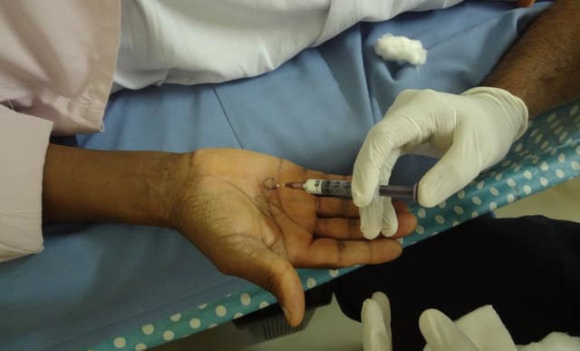Steroid injection into Dupuytren's nodules