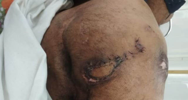 The same area after reconstructive surgery, with stitches